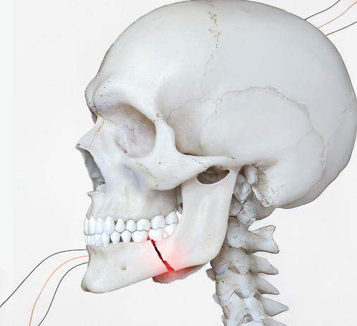 Trauma lento e bucomaxilofacial