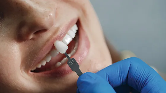 Lentes de Contato Dental: a arte do sorriso ideal