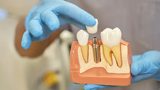 Prótese sobre Implante: o sorriso fixo e natural